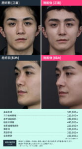 鼻整形のビフォーアフターと料金詳細02