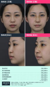 鼻整形のビフォーアフターと料金詳細03