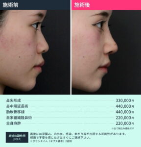 鼻整形のビフォーアフターと料金詳細04