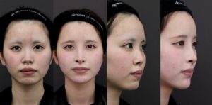 鼻整形のビフォーアフターと料金詳細05