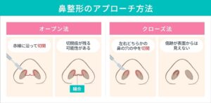 鼻整形術のオープン法とクローズ法の図解