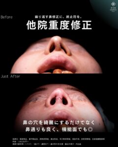 重度鼻整形のビフォーアフター 下からの角度
