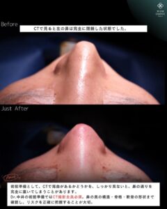 重度鼻整形のビフォーアフター 上からの角度