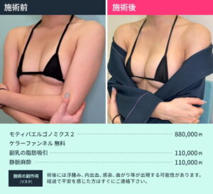 シリコンバッグ豊胸のビフォーアフター