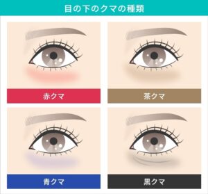 目の下のクマの種類のイラスト