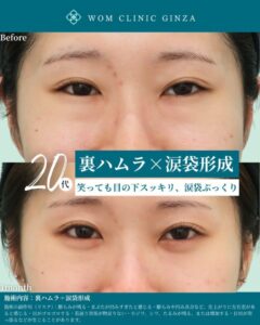 目の下のクマとたるみ治療前後の比較