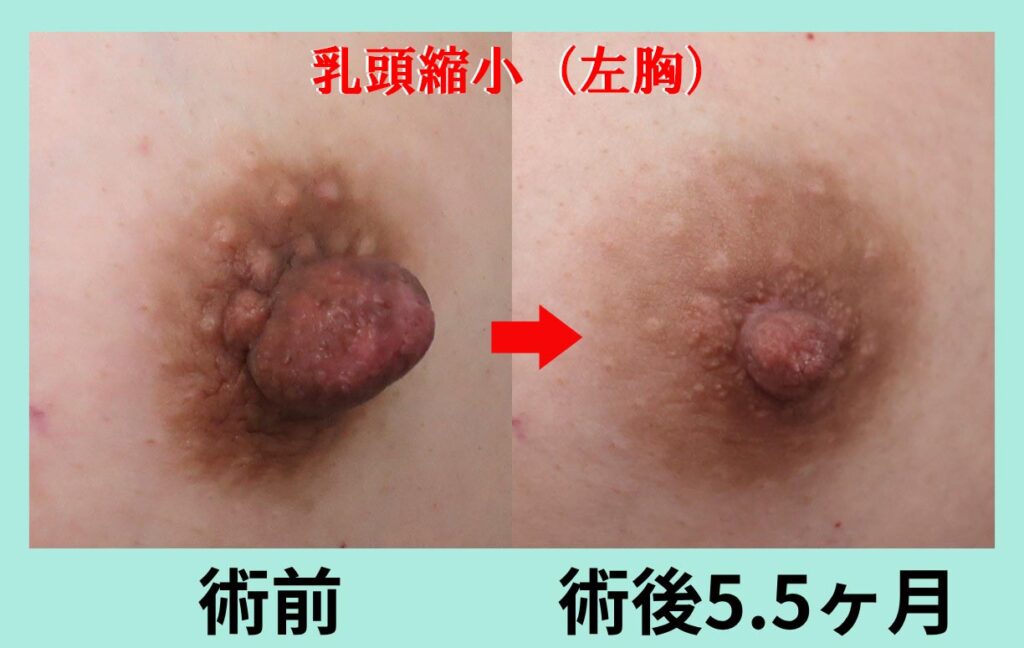 『これが、匠の技の「乳頭縮小術」　細かな技が光るベテランの縮小手術を解説。』の画像