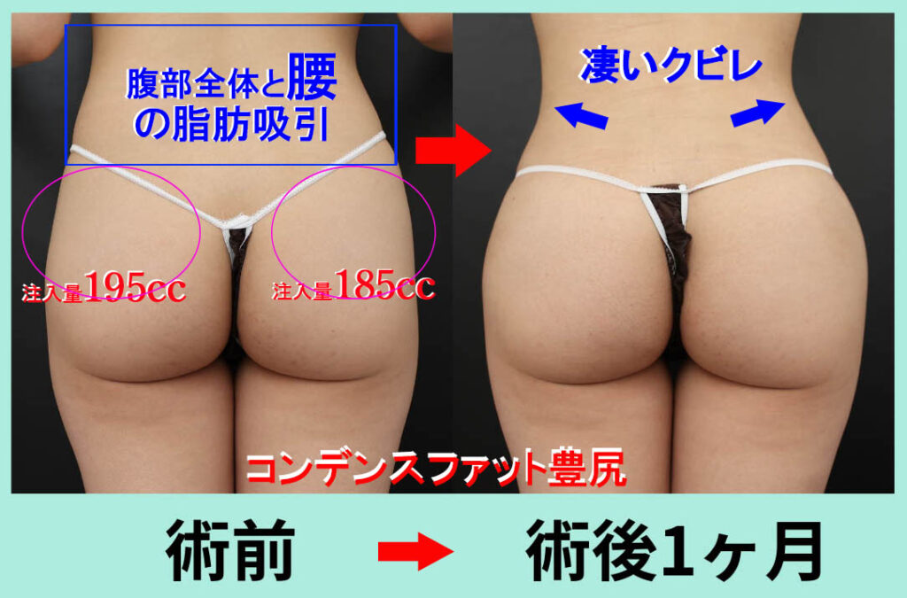 ブラジリアンバットリフト CRF脂肪注入 豊尻