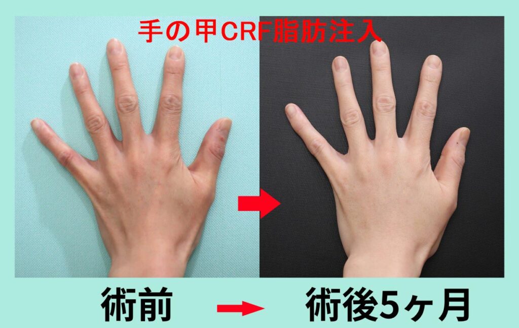 『驚異の「手の甲」アンチエイジング！ CRF脂肪注入で、綺麗でスベスベの手になります。』の画像
