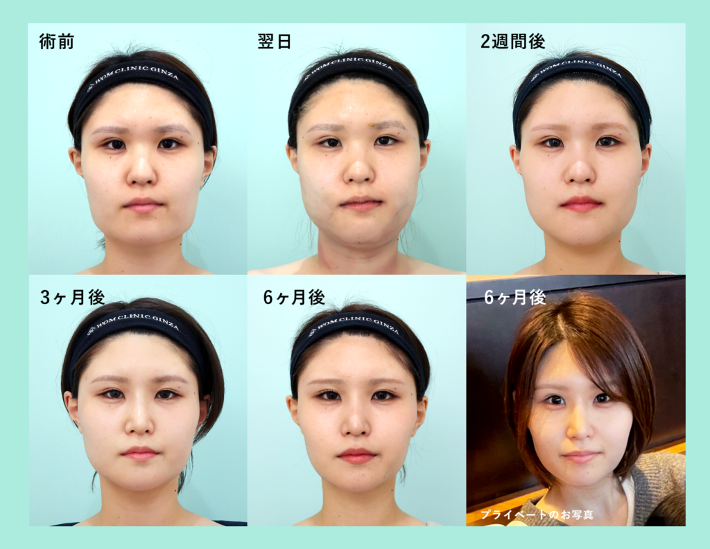 『エラの張り出しを解消!【 Vライン形成+頬顎脂肪吸引 】』の画像
