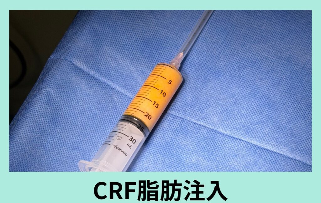 『驚異の「手の甲」アンチエイジング！ CRF脂肪注入で、綺麗でスベスベの手になります。』の画像