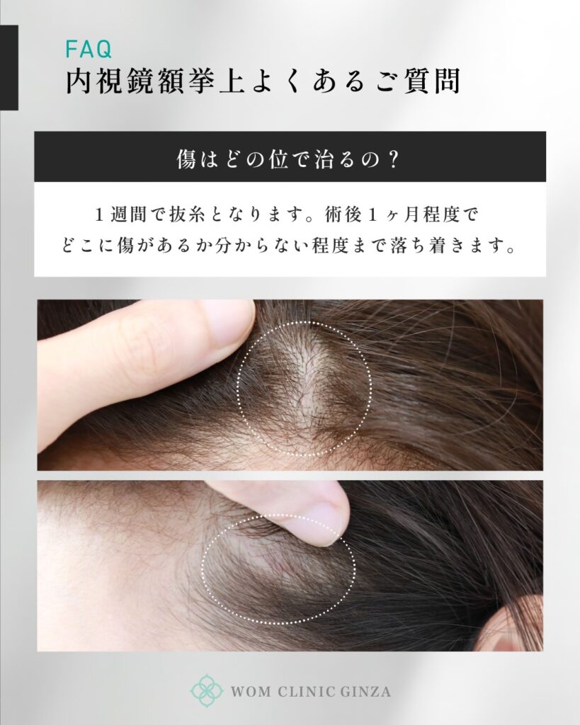 『「後戻りするって本当？」内視鏡額挙上の6ヶ月リアル経過を大公開』の画像