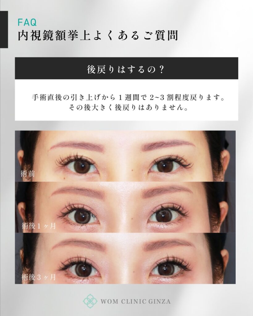 『「後戻りするって本当？」内視鏡額挙上の6ヶ月リアル経過を大公開』の画像