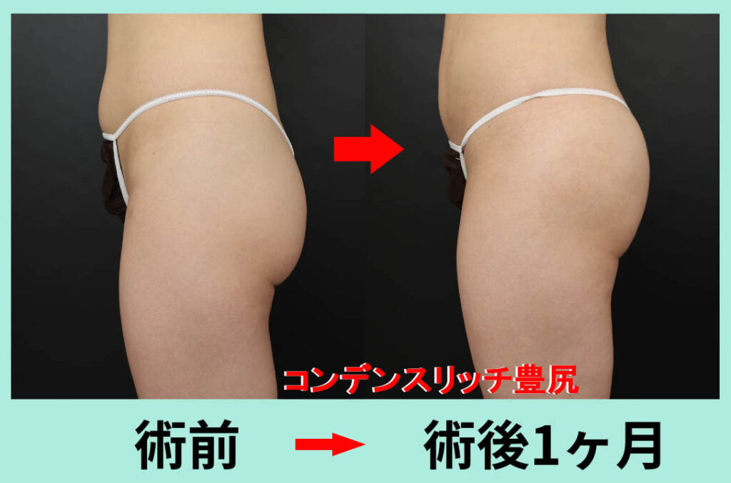 ブラジリアンバットリフト CRF脂肪注入 豊尻