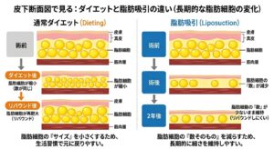 『【二年後の腕は？】脂肪吸引は「リバウンドしない」と言われる医学的理由と長期経過解説。』の画像
