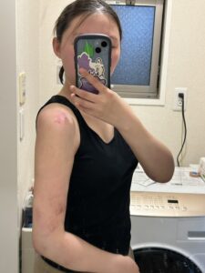 『【ダウンタイム毎日経過公開】二の腕脂肪吸引を考えている方は必見です。』の画像
