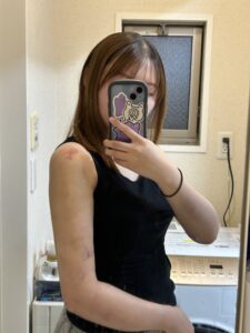 『【ダウンタイム毎日経過公開】二の腕脂肪吸引を考えている方は必見です。』の画像