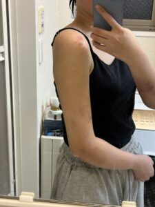 『【ダウンタイム毎日経過公開】二の腕脂肪吸引を考えている方は必見です。』の画像