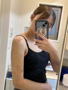 『【ダウンタイム毎日経過公開】二の腕脂肪吸引を考えている方は必見です。』の画像