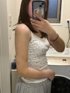 『【ダウンタイム毎日経過公開】二の腕脂肪吸引を考えている方は必見です。』の画像