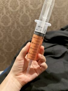 『【ダウンタイム公開】脂肪で埋もれたフェイスラインは小顔脂肪吸引で1日で救出できます。』の画像