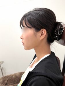 『【ダウンタイム公開】脂肪で埋もれたフェイスラインは小顔脂肪吸引で1日で救出できます。』の画像