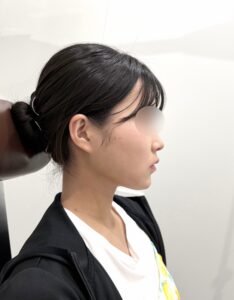 『【ダウンタイム公開】脂肪で埋もれたフェイスラインは小顔脂肪吸引で1日で救出できます。』の画像