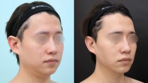 『修正施術でイケメンに『真のメンズ小顔術』』の画像