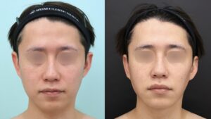 『修正施術でイケメンに『真のメンズ小顔術』』の画像