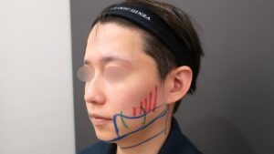 『修正施術でイケメンに『真のメンズ小顔術』』の画像