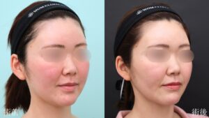 『長年のコンプレックスを解消!脂肪吸引で輪郭を洗練。』の画像