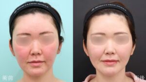 『長年のコンプレックスを解消!脂肪吸引で輪郭を洗練。』の画像