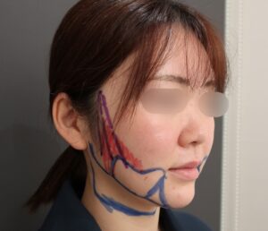 『長年のコンプレックスを解消!脂肪吸引で輪郭を洗練。』の画像