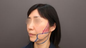 『50代でも顔の脂肪吸引?切らない治療で叶える輪郭アップデート。』の画像