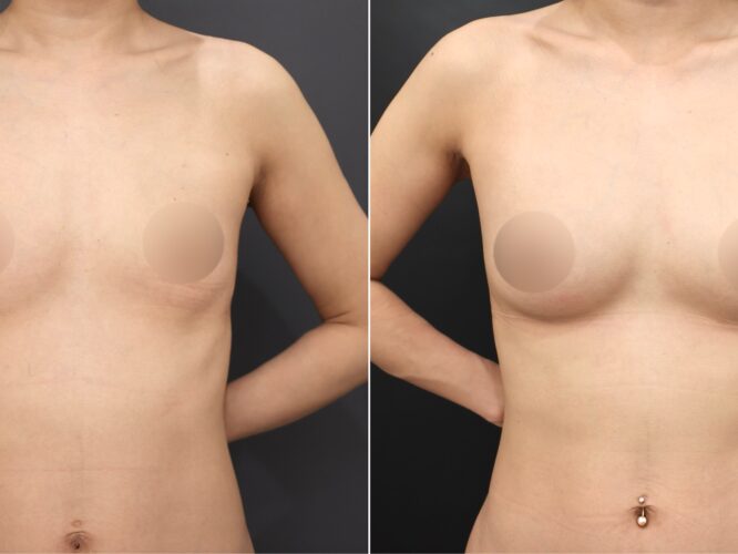 脂肪豊胸　CRF豊胸　授乳後