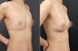 『【30代・授乳後バスト】太もも脂肪吸引＋CRF豊胸で自然なボリューム改善を』の画像