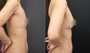 『【30代・授乳後バスト】太もも脂肪吸引＋CRF豊胸で自然なボリューム改善を』の画像