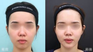 『垢抜の鍵はフェイスラインに・理想を叶える小顔脂肪吸引』の画像