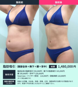 腹部の脂肪吸引のビフォーアフター