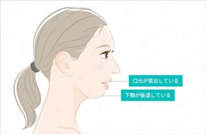アデノイド顔貌の特徴