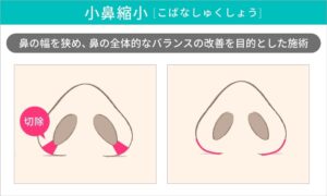 小鼻縮小術の術前と術後のイラスト