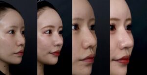 女性の鼻のビフォーアフター比較画像