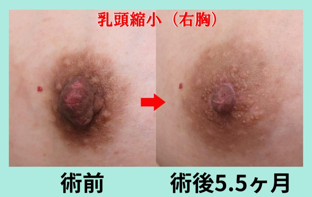 『これが、匠の技の「乳頭縮小術」　細かな技が光るベテランの縮小手術を解説。』の画像