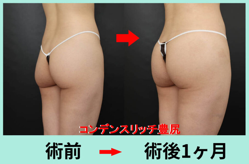 ブラジリアンバットリフト CRF脂肪注入 豊尻