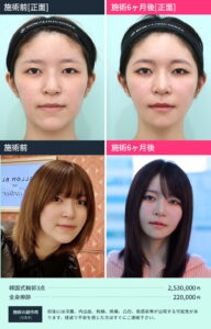 女性の施術前と施術後を比較した画像