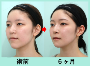 術前と術後6ヶ月の女性の顔の比較