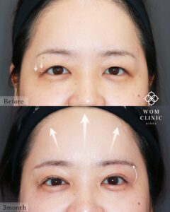 施術前後で眉毛とまぶたの位置が変化した女性の顔