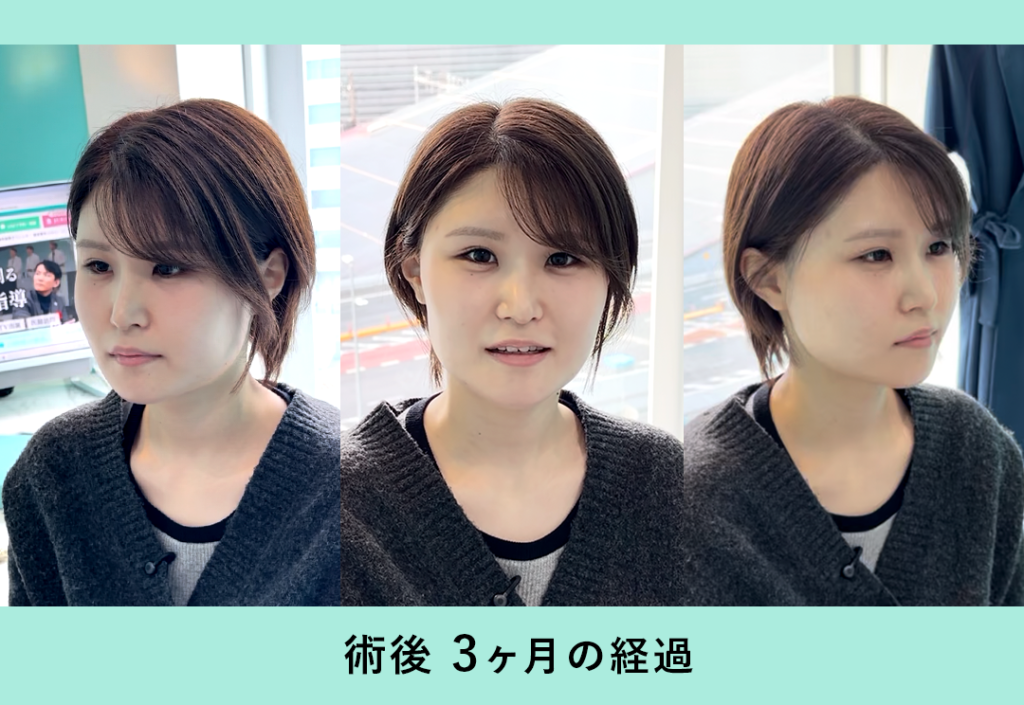 『エラの張り出しを解消!【 Vライン形成+頬顎脂肪吸引 】』の画像