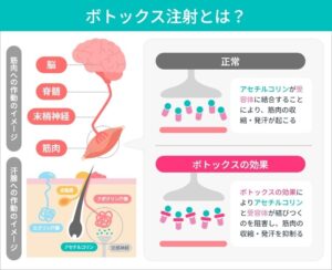 ボトックス注射の作用機序