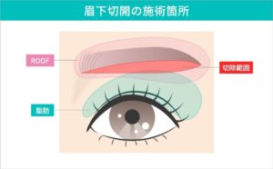 眉下切開の施術範囲と脂肪の位置図